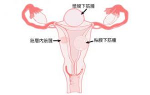 子宮筋腫の種類の説明