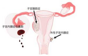 子宮内膜症の説明